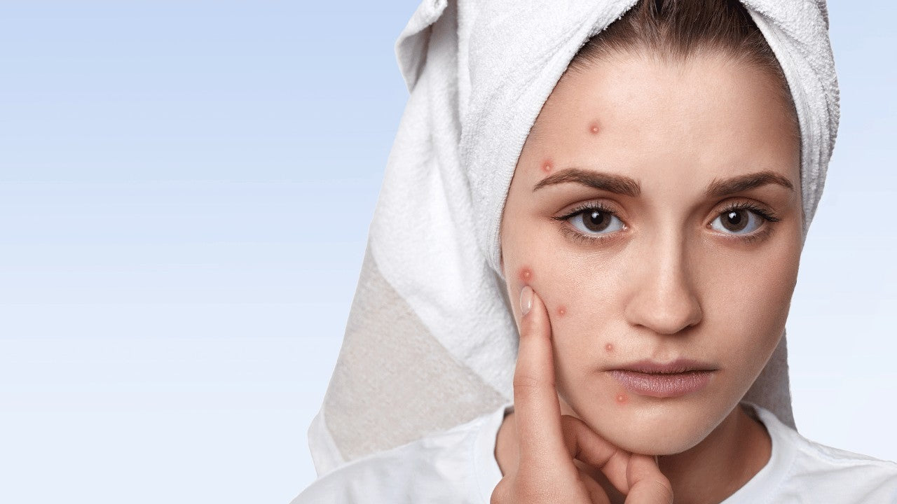 Best Acne Supplements For Men & Women
