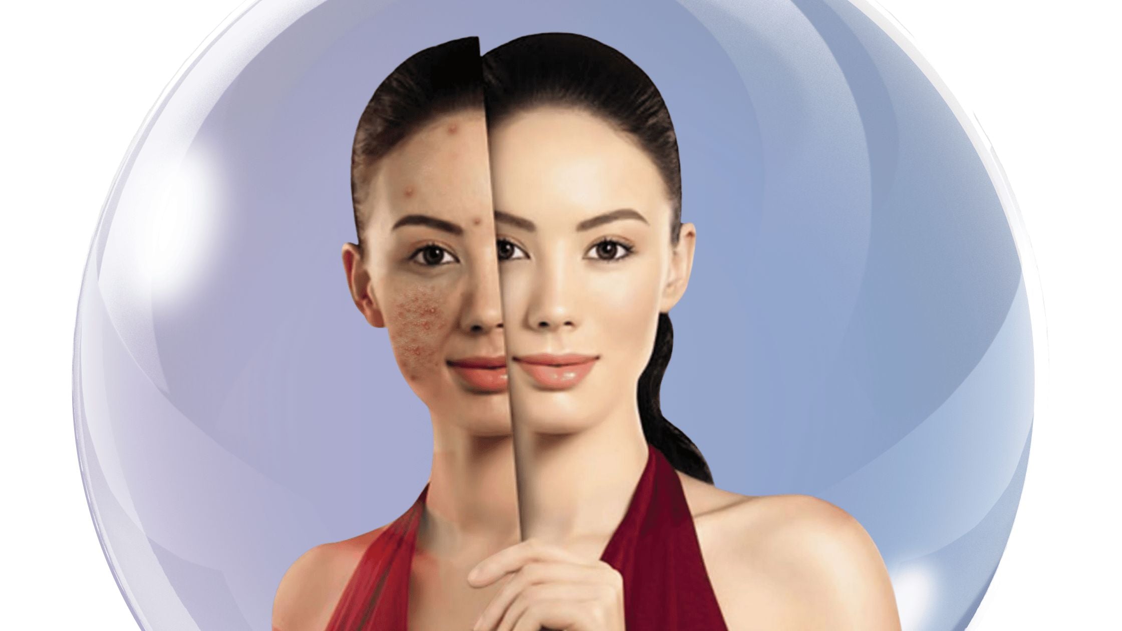 Fix Hormonal Acne For REAL | Becura