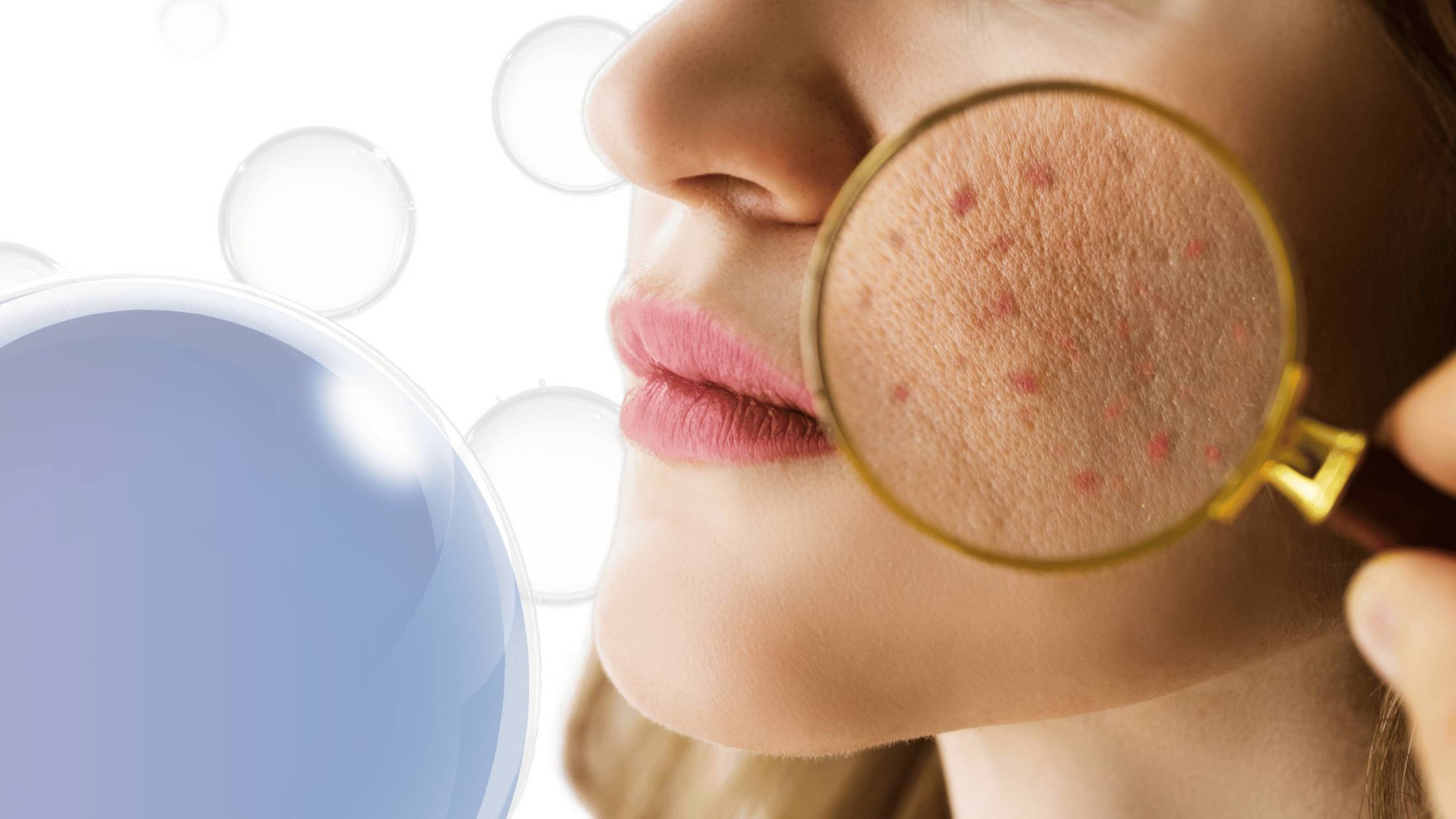 Acne Supplements For Men