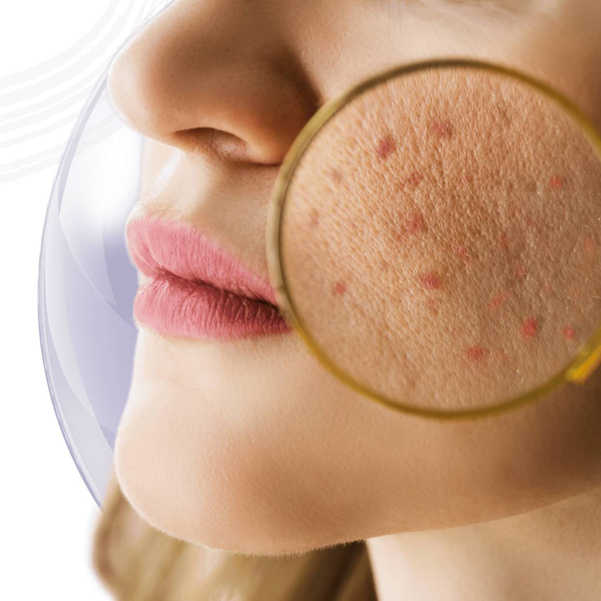 l carnitina produce acne Top 6 Foods That Can Cause Acne