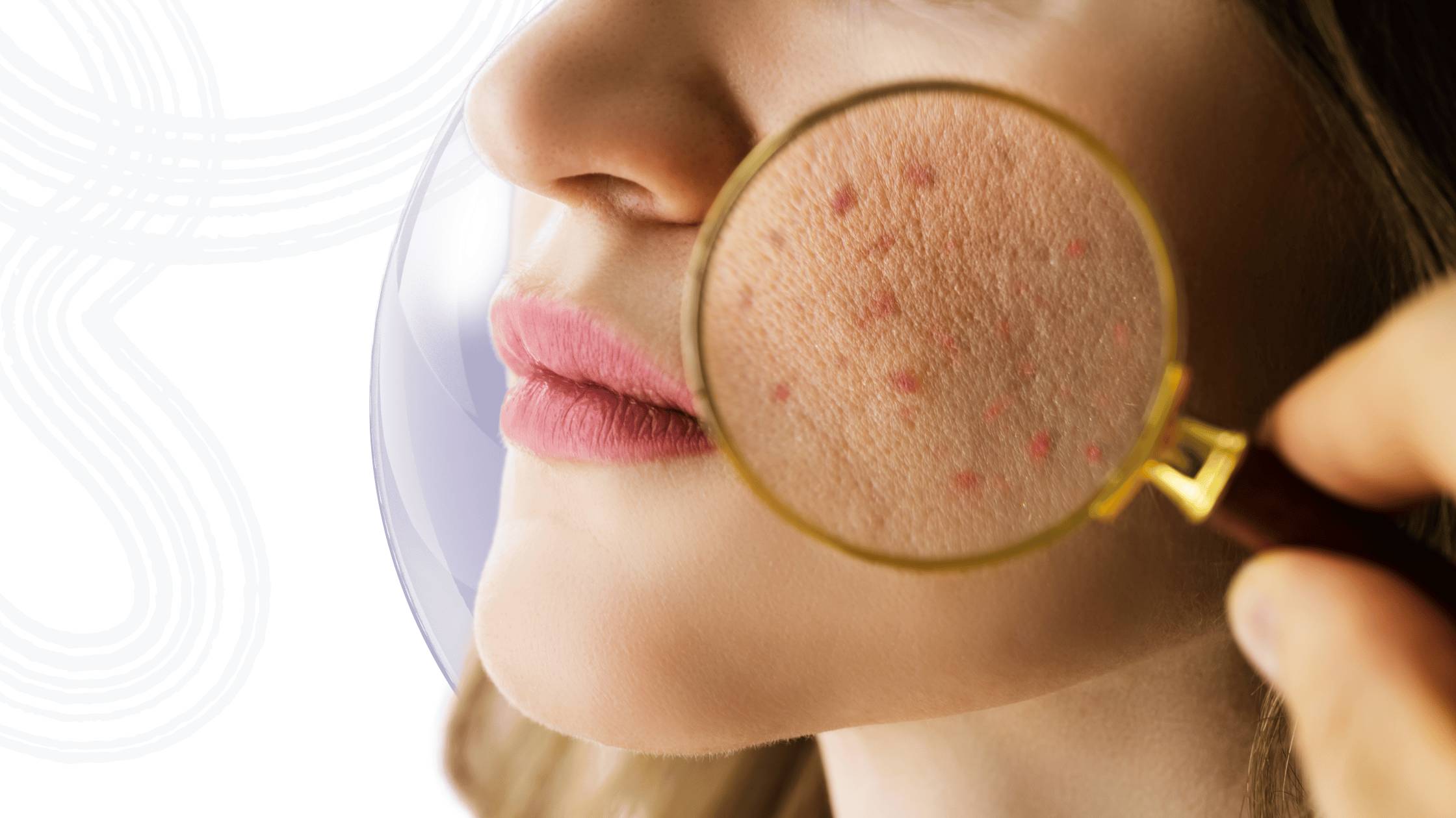 Top 6 Foods That Can Cause Acne