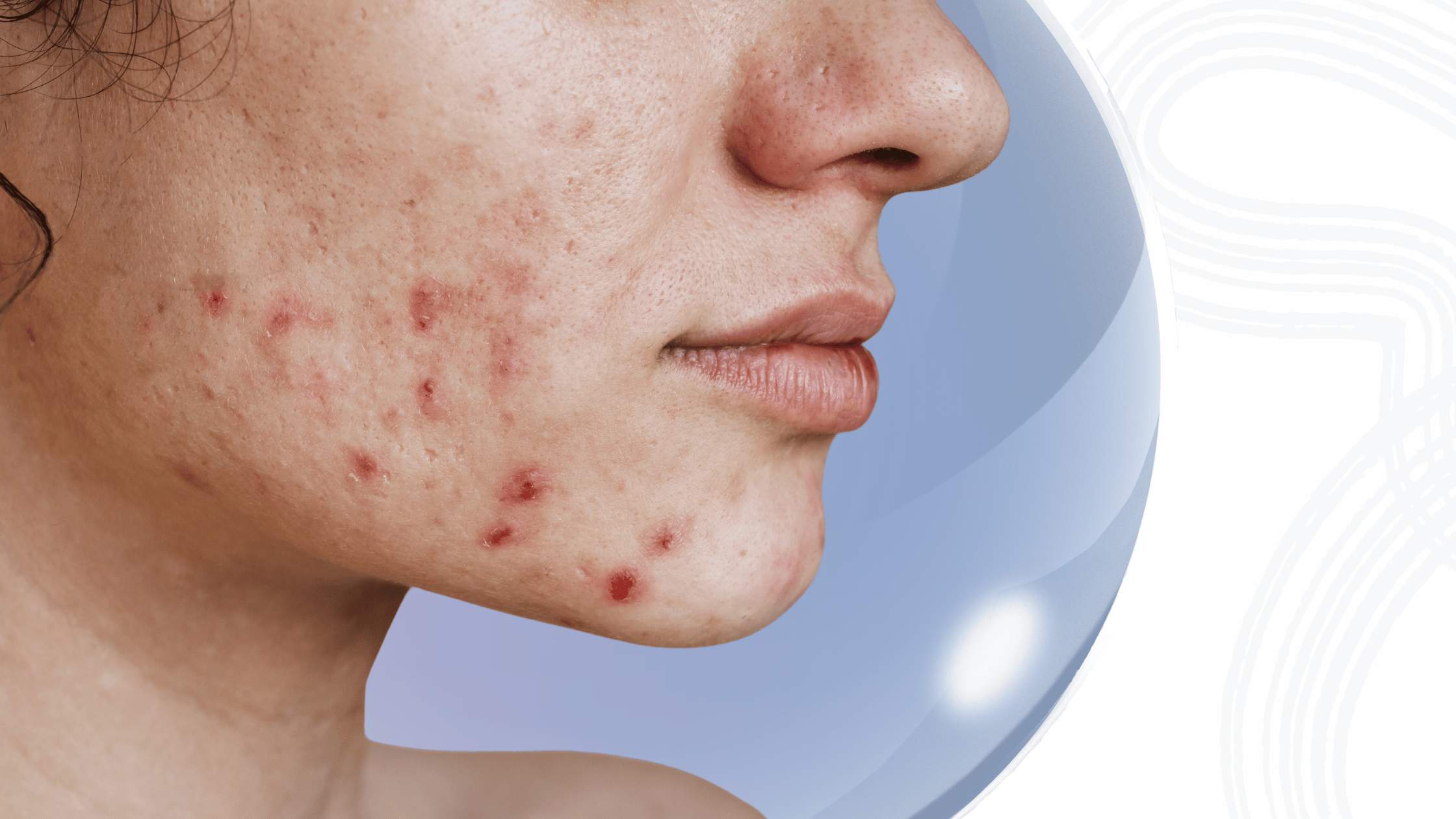 Nicotinamide for Acne