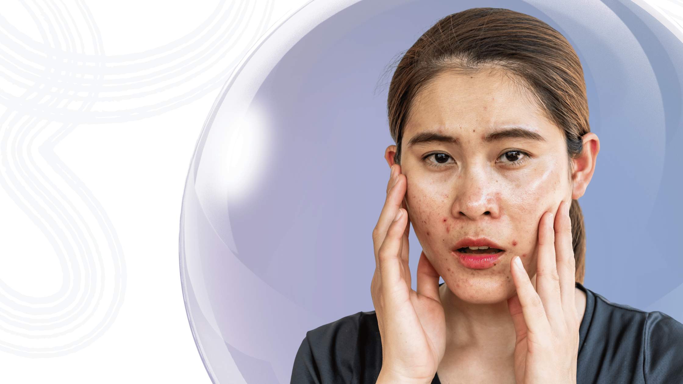 Acne Supplements